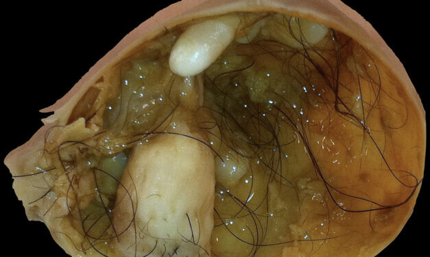 Is This Magic? Tumours Containing Teeth, Hair, Bone And Muscles