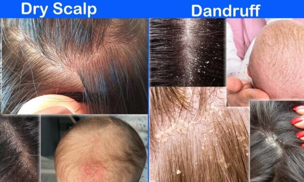 Dandruff vs dry scalp: Differences, similarities, and treatment