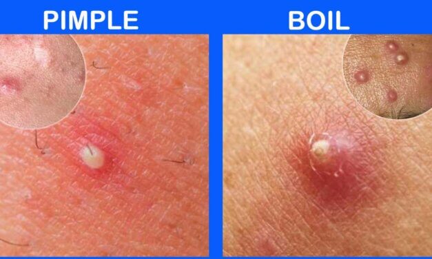 Boil vs pimple: Differences, similarities, treatment, and prevention